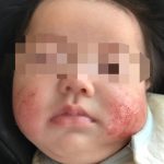 乳児湿疹が顔に出た際の対処法、治し方でだんだんと治まっていく方法って？