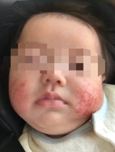 乳児 湿疹 顔 だけ 赤ちゃんの顔にできる湿疹やブツブツの症状 原因 対策法は